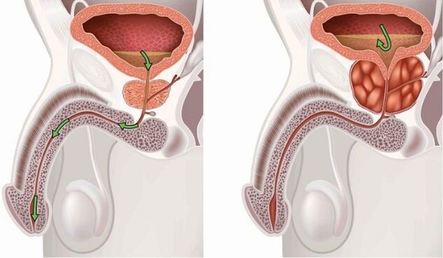 A healthy and sick prostate