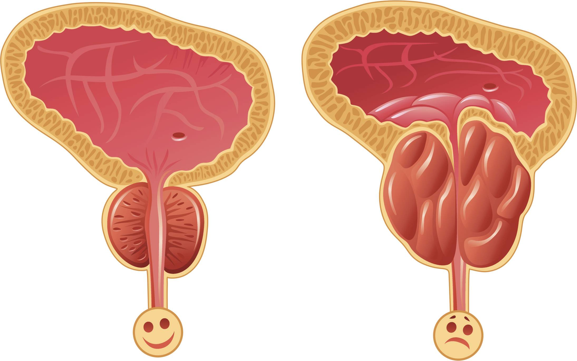 How to determine the presence of prostatitis